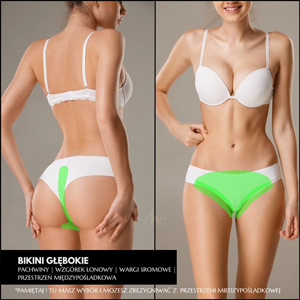 Epilacja laserowa bikini głębokie